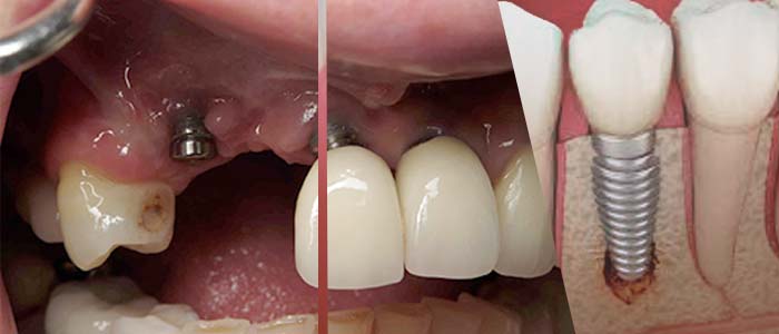 Implantes dentales infectados