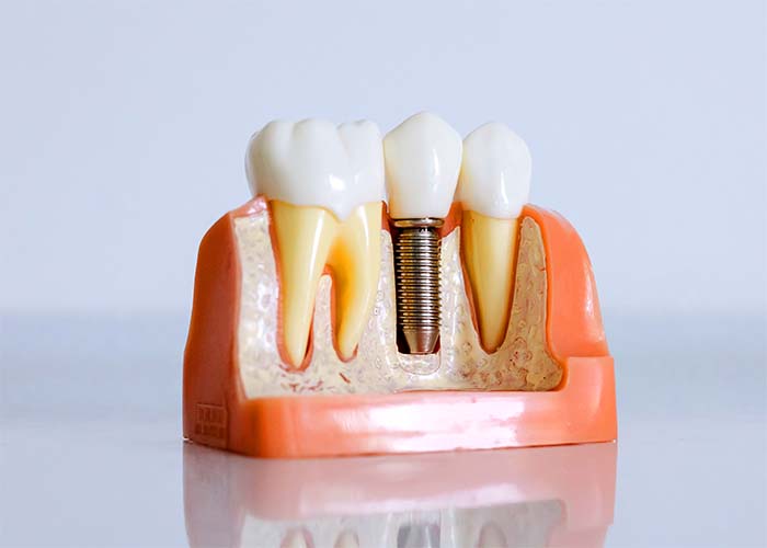 implante dental barato