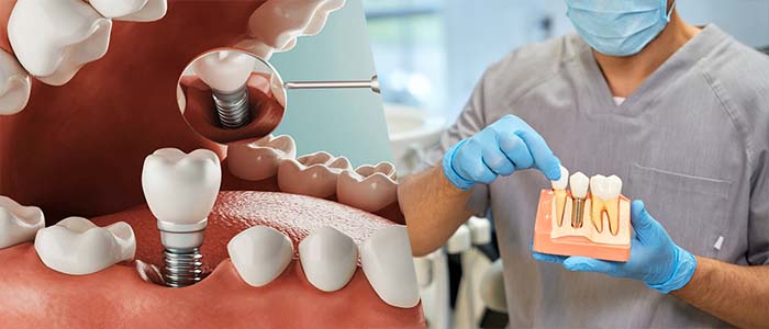 implantes dentales complicaciones largo plazo