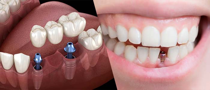 implantes dentales las fases