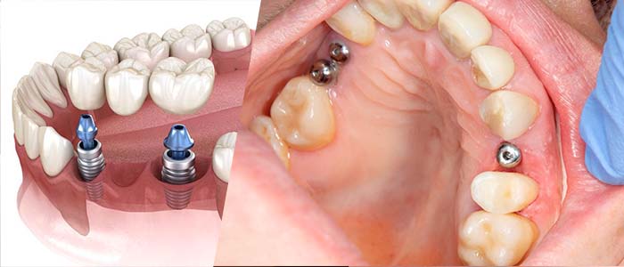 implantes dentales materiales
