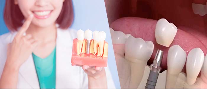 implantes dentales riesgos
