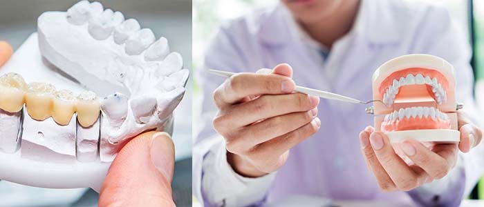 materiales de las protesis dentales