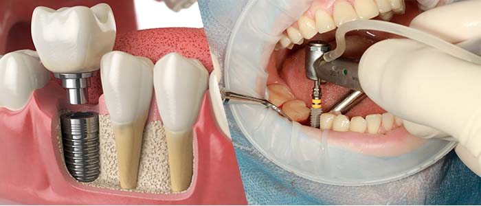 Proceso de los implantes dentales