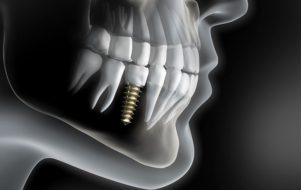 duracion de implante dental