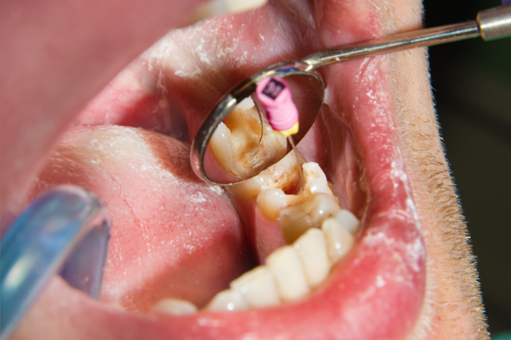 duracion de endodoncia