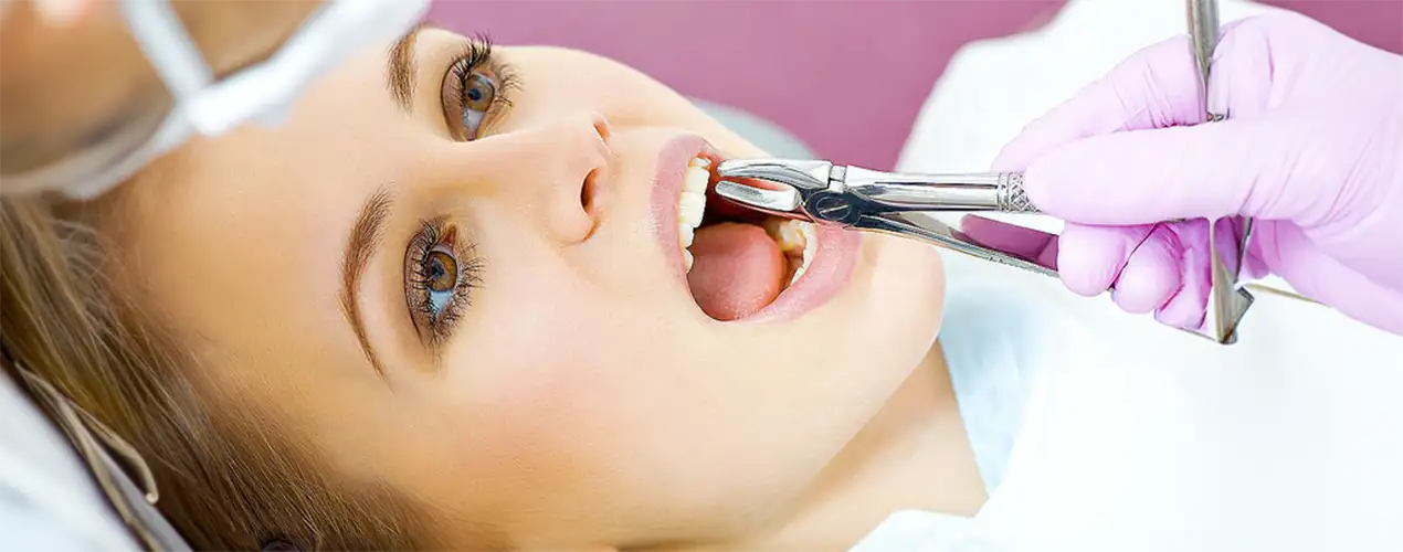 tratamiento de extraccion de dientes